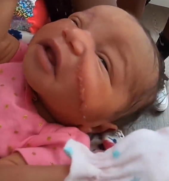 Bé gái vừa chào đời đã phải khâu 13 mũi vì bị bác sĩ rạch vào mặt trong lúc mổ  - Ảnh 2.