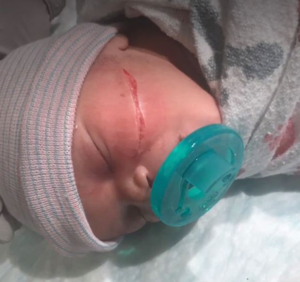 Bé gái vừa chào đời đã phải khâu 13 mũi vì bị bác sĩ rạch vào mặt trong lúc mổ  - Ảnh 1.