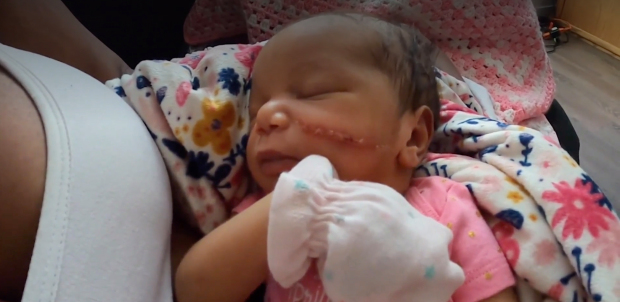 Bé gái vừa chào đời đã phải khâu 13 mũi vì bị bác sĩ rạch vào mặt trong lúc mổ  - Ảnh 3.