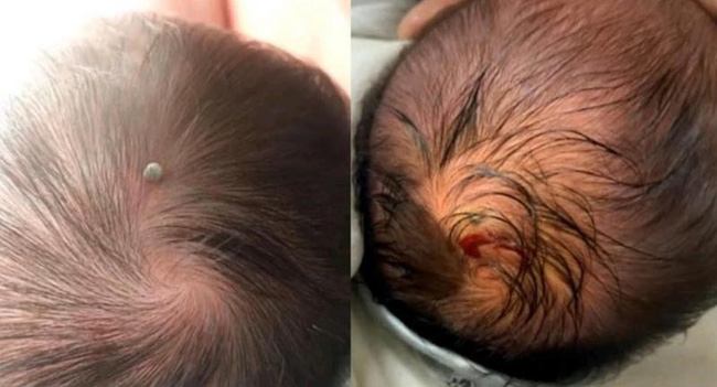 Bé sơ sinh 4 ngày tuổi bị ve chó cắn trên đầu, bố mẹ không lấy tay gỡ ra cho con liền được bác sĩ khen ngợi - Ảnh 1.