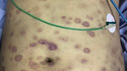 Quảng Ninh: Người đàn ông tử vong do ăn hàu sống