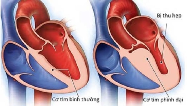 Viêm cơ tim sau tiêm vaccine COVID- 19 có đáng ngại? - Ảnh 1.