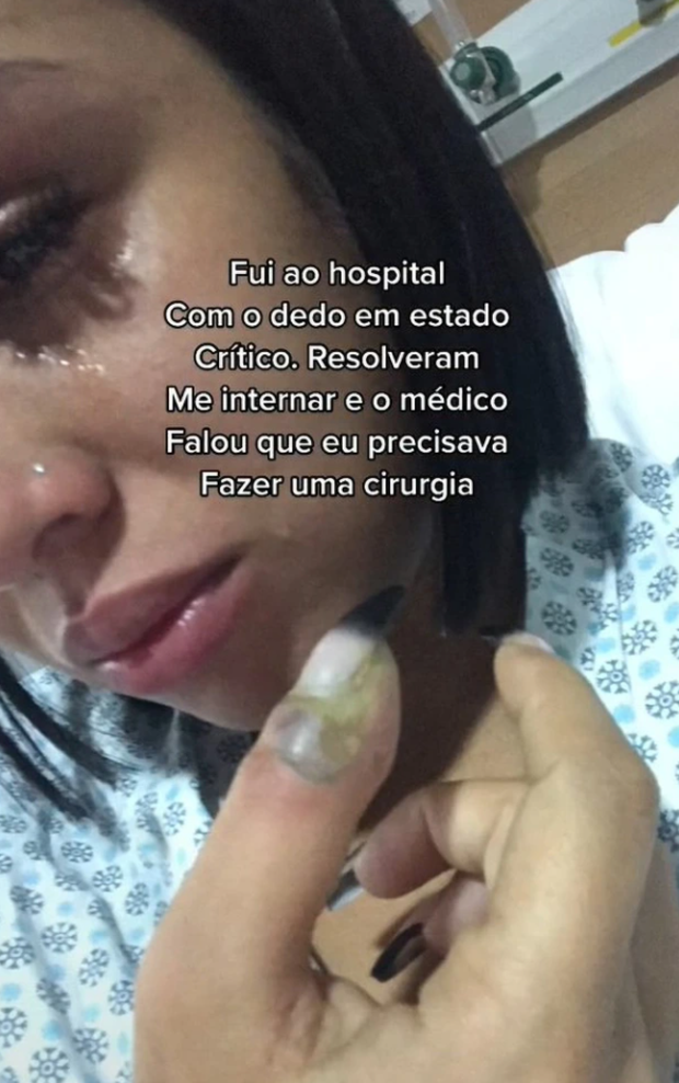 Ngón tay cái của cô gái bị sưng đau, chảy mủ sau khi làm móng, bị viêm mô tế bào, bác sĩ chỉ định phải cắt cụt để giữ tính mạng - Ảnh 2.