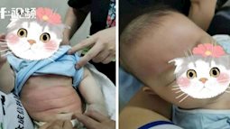 Tin vào bài thuốc hạ sốt dân gian của người nhà, bé trai 4 tháng tuổi bị nổi mẩn đỏ toàn thân