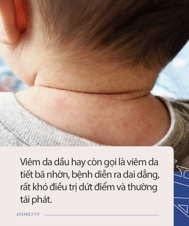 Nam diễn viên Đài Loan tiết lộ con trai bị bệnh về da, ga giường thường xuyên dính máu. Căn bệnh này đáng sợ như thế nào đối với trẻ nhỏ? - Ảnh 3.