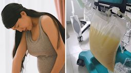 Ăn quá nhiều chân giò hầm, người phụ nữ đang mang thai 28 tuần tuổi nhập viện trong tình trạng nguy kịch, nhìn lượng mỡ tách ra từ máu gây sốc