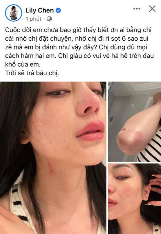 Gì đây: Lily Chen tung loạt ảnh bị hành hung, tiết lộ ai đó đặt chuyện hãm hại giữa drama với nữ hoàng nội y? - Ảnh 2.