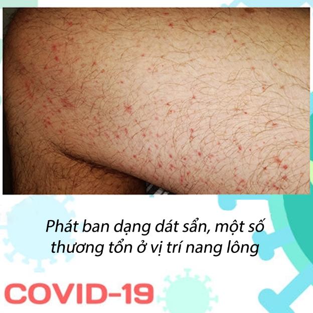 Phát ban có phải là dấu hiệu của COVID-19 không? - Ảnh 3.