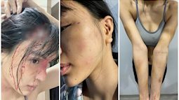 Vụ nữ siêu mẫu Khả Trang bị giam lỏng và bạo hành dã man: Người chồng bị tố có thể phải đối mặt hình phạt nào?