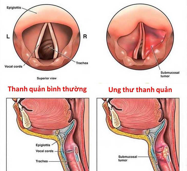 Ung thư thanh quản: Dấu hiệu, nguyên nhân, điều trị và tiên lượng - Ảnh 2.