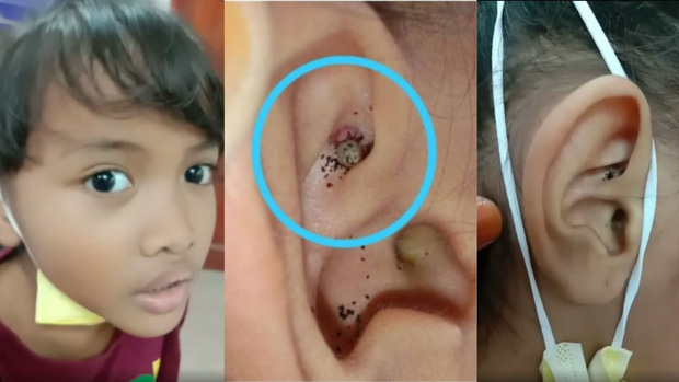 Cậu bé 6 tuổi đau nhức và nghe tiếng động lạ trong tai, đi nội soi bác sĩ hốt hoảng khi thấy con vật đang làm tổ bên trong - Ảnh 1.