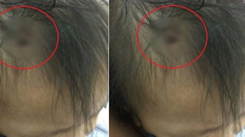 Sự thật về bức ảnh chiếc đinh găm vào đầu cháu bé được cho là nạn nhân nghi án bạo hành ở Hà Nội