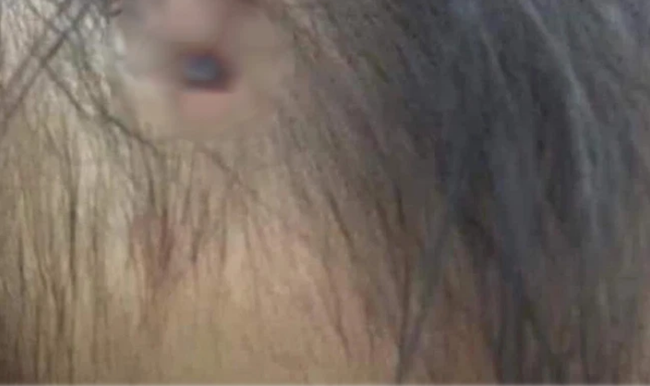Thực hư hình ảnh chiếc đinh găm vào đầu cháu bé nghi trong vụ bạo hành ở Hà Nội đang lan truyền trên MXH - Ảnh 1.
