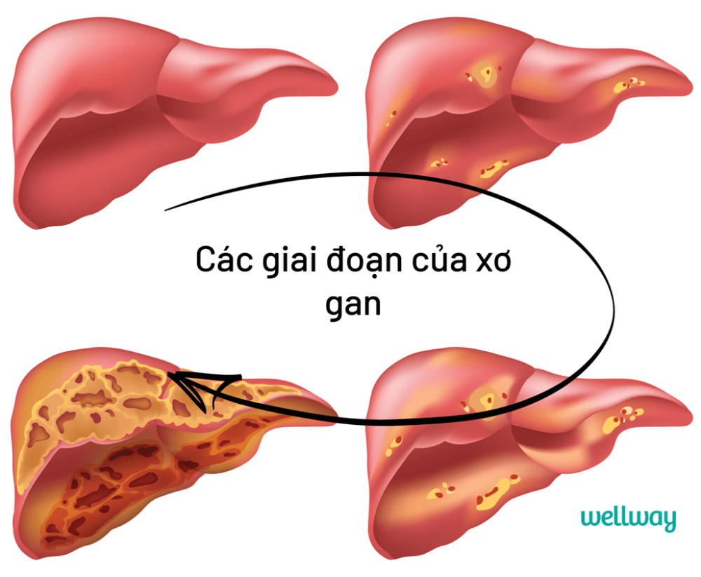 5 dấu hiệu cảnh báo gan của bạn đang nhiễm độc - Ảnh 1.