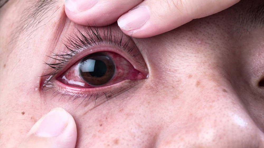 Mắt đỏ au sau khi mắc Covid-19: Bằng chứng cho thấy virus SARS-CoV-2 tác động tới mắt - Ảnh 1.