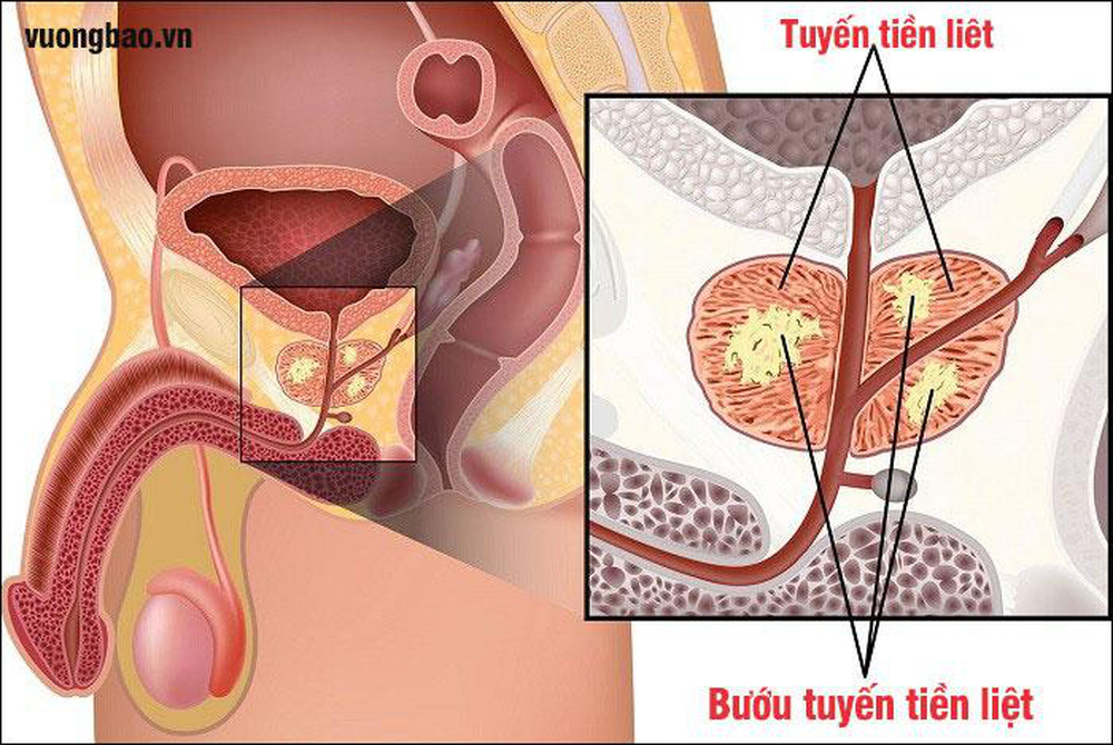 Căn bệnh chỉ đàn ông mắc, không điều trị sớm có thể tử vong: Cách giảm nguy cơ ít tốn tiền - Ảnh 2.