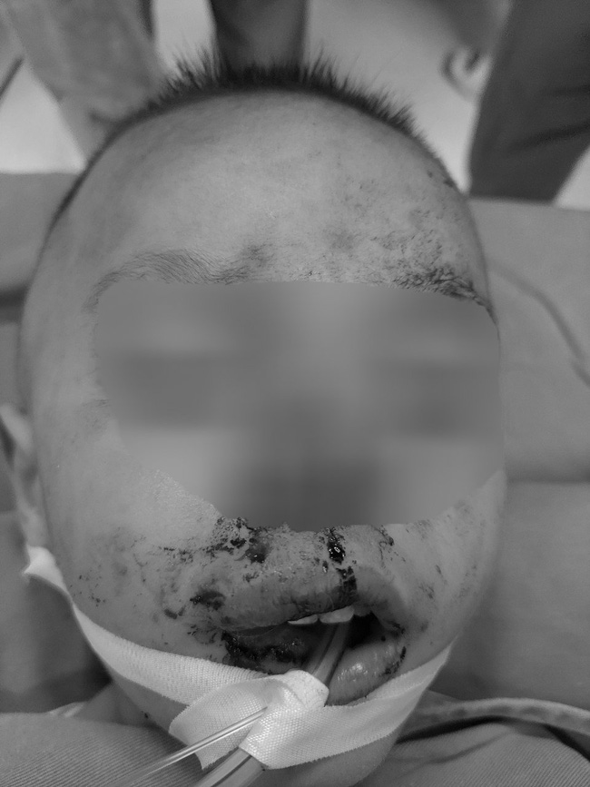 Bé trai 2 tuổi chi chít vết thương ở mặt do bị chó hàng xóm cắn - Ảnh 1.