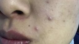 Nữ sinh 18 tuổi đột nhiên mọc mụn kín mặt, tưởng căng thẳng vì thi đại học ai ngờ phát hiện nhiễm virus HPV dù chưa từng quan hệ cũng không có bạn trai