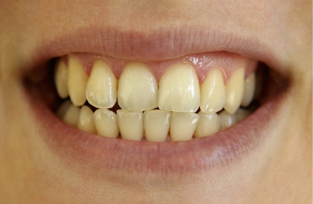 3 nguyên nhân không ngờ khiến răng bị ố vàng, xỉn màu, kiểm tra xem bạn có đang mắc phải vấn đề nào không - Ảnh 1.