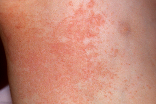 6 vấn đề của làn da khi nắng nóng và mẹo để phục hồi - Ảnh 1.