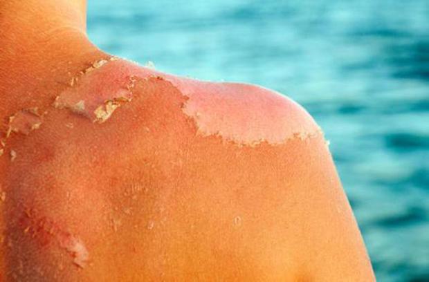 6 vấn đề của làn da khi nắng nóng và mẹo để phục hồi - Ảnh 2.