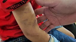 Vụ cháu bé 9 tuổi bị đánh đập dã man: Phát hiện xương bàn tay bị gãy