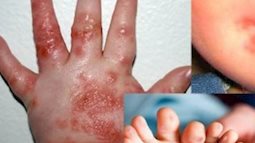 Trẻ có thể bị tay chân miệng và sốt xuất huyết cùng lúc không? Phân biệt vết loét do tay chân miệng gây ra
