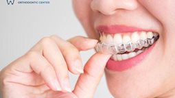 9 câu hỏi thường gặp về niềng răng trong suốt Invisalign