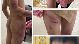 Hải Phòng: Học sinh lớp 2 nghi bị bạn trai của mẹ đánh đập, bầm tím khắp người