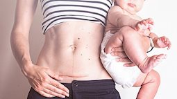 4 lỗi mẹ sinh mổ thường hay mắc dẫn đến thời gian phục hồi chậm và nguy cơ tai biến cao