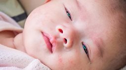 Cảnh giác khi bé sốt xuất huyết 'giả dạng' là sốt phát ban