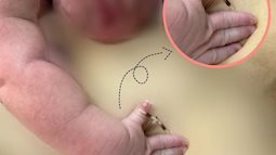 Hi hữu bé gái chào đời cùng vòng tránh thai: Tại sao đặt vòng vẫn có thai?