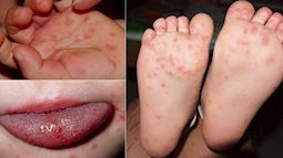 TP. Hồ Chí Minh: Enterovirus 71 gây bệnh tay chân miệng nặng ở trẻ em đã xuất hiện trở lại