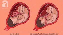 Dây rốn quấn 2 vòng quanh cổ thai nhi, thói quen này khi mang thai của người mẹ là thủ phạm