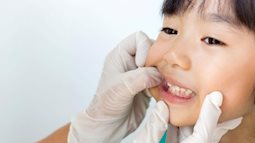 Niềng răng cho trẻ: giải pháp nào định hình khớp cắn hiệu quả nhất?