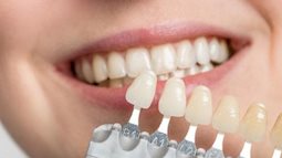 Bọc răng sứ Cercon - Giải pháp phục hình răng thẩm mỹ hoàn hảo