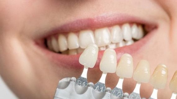 Bọc răng sứ Cercon - Giải pháp phục hình răng thẩm mỹ hoàn hảo