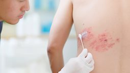 Chuyên gia cảnh báo: Hơn 90% người Việt Nam trưởng thành mang sẵn virus này, cứ 3 người thì có 1 người phát bệnh