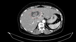 Vàng da tưởng sỏi mật, đi khám phát hiện cùng lúc hai ung thư